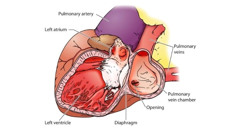 Cor triatriatum surgery life saving correction for patients
