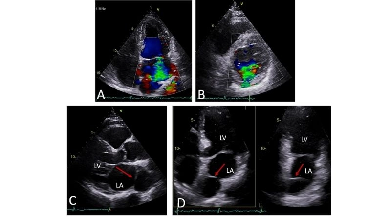 Congenital heart defect serious condition present at birth
