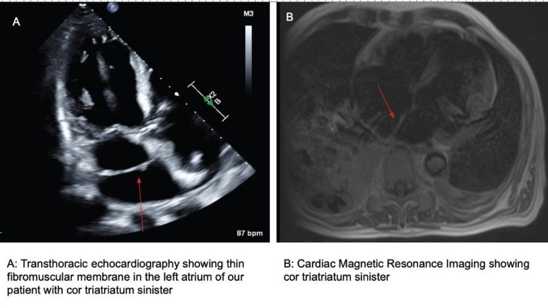 Triatrial heart unusual heart with three atrial chambers