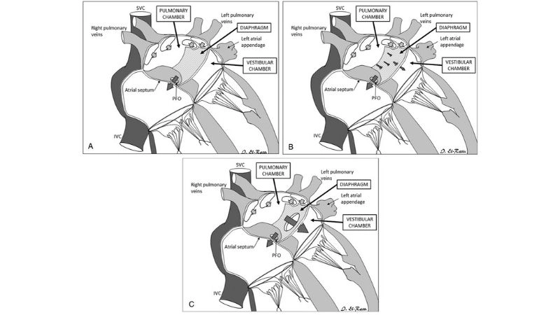 Cor triatriatum prognosis survival depends on intervention