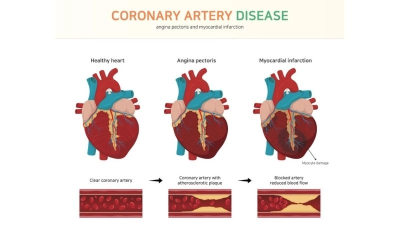 Lifesaving options for coronary artery disease treatment