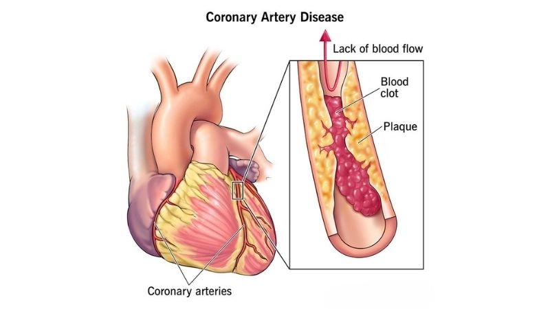 Smart lifestyle tips for coronary artery disease prevention