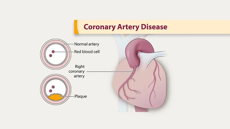 Atherosclerosis leading to narrowed blood vessels