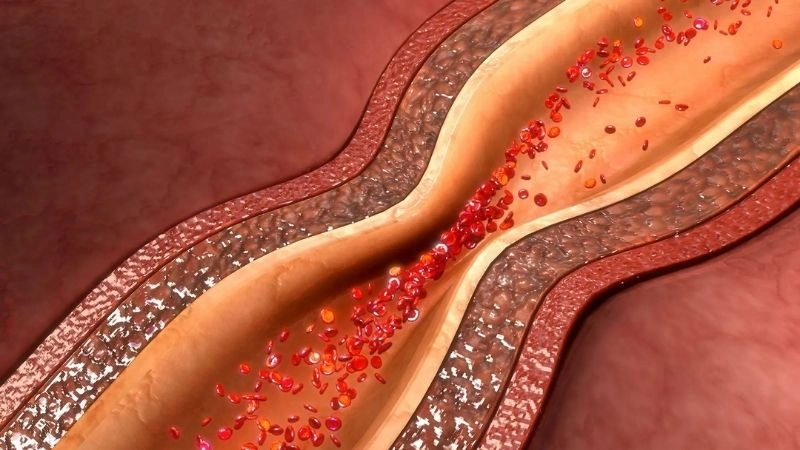 Alarming cases of spasm in heart revealed