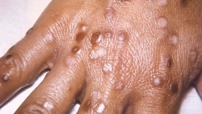 Cowpox in cats causes skin rash