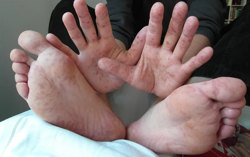 An adult with hand foot and mouth disease discomfort