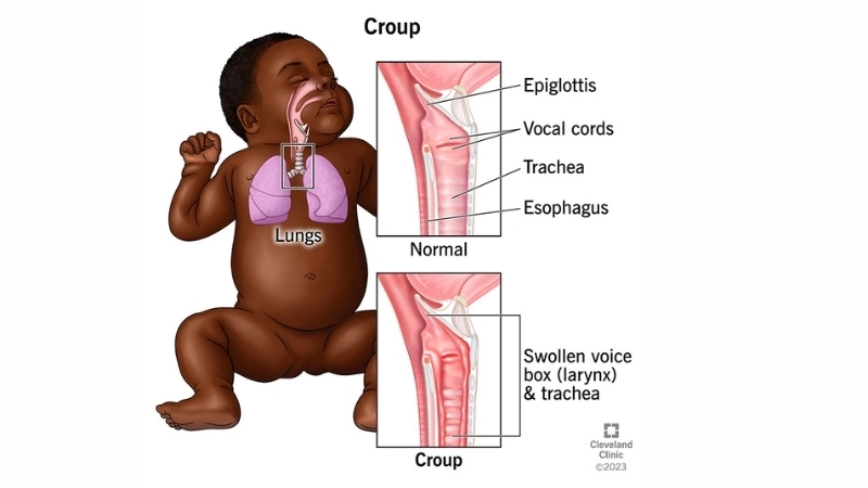 The seal-like bark is a classic croup cough sound