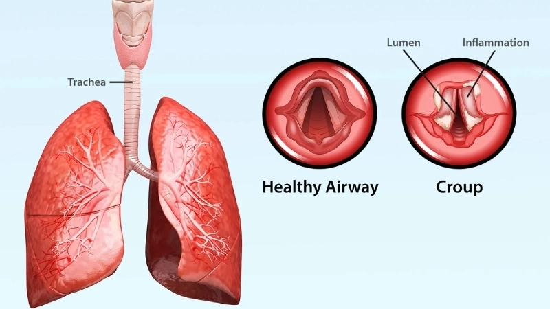 Timeline of croup: how long does it last
