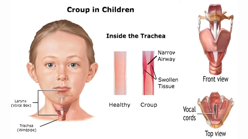 An infographic explaining the risks of adult croup