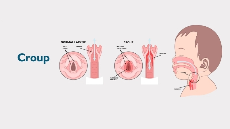 Recognizing the common croup symptoms in a toddler