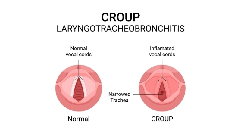 Monitoring a baby with croup in a newborn