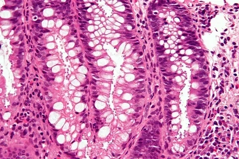 Infographic explaining what is cryptosporidiosis