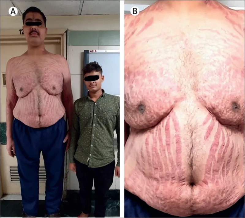 Medical chart detailing Cushing's disease diagnosis