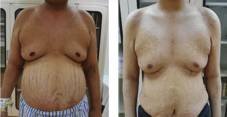 Person with moon face due to hormonal imbalance