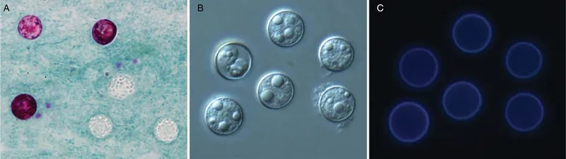 Watery diarrhea and fatigue are cyclosporiasis symptoms