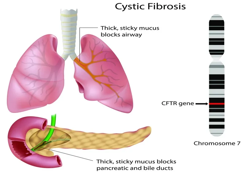 Identifying cystic fibrosis symptoms for early detection