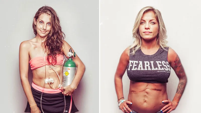 Sweat test for cystic fibrosis in early screening