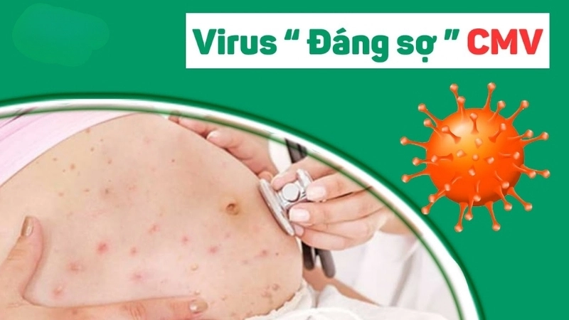 Cytomegalovirus (CMV) Infection cmv treatment