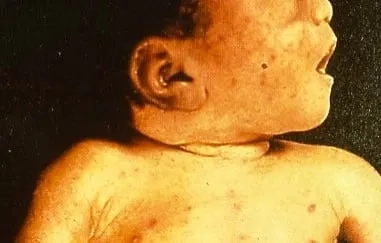 Identifying cytomegalovirus symptoms in adults