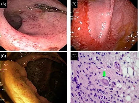 Congenital cytomegalovirus long term effects in children