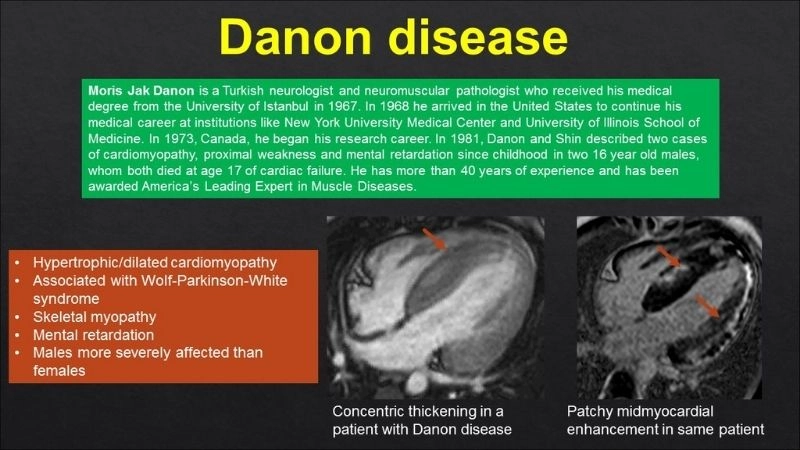 Danon disease symptoms early signs of heart and muscle involvement