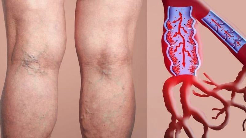 DVT prevention with lifestyle and medical care