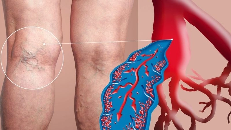 What is DVT and why it threatens circulation