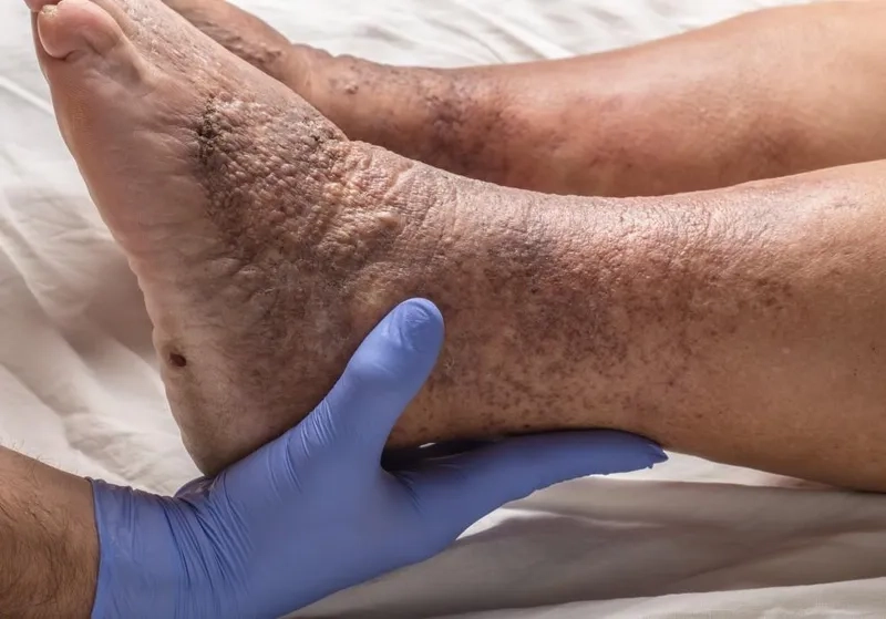 An overview of modern DVT treatment options