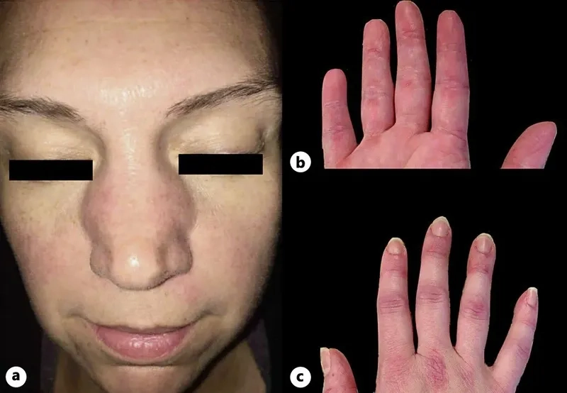 An infographic explaining what is dermatomyositis