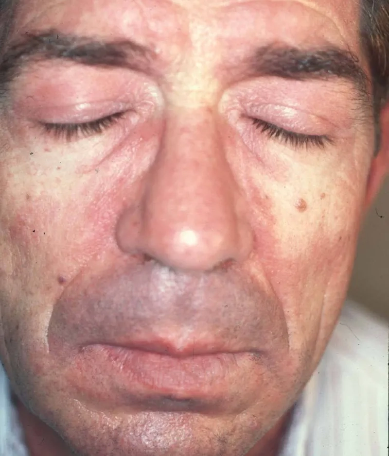 An overview of dermatomyositis treatment options