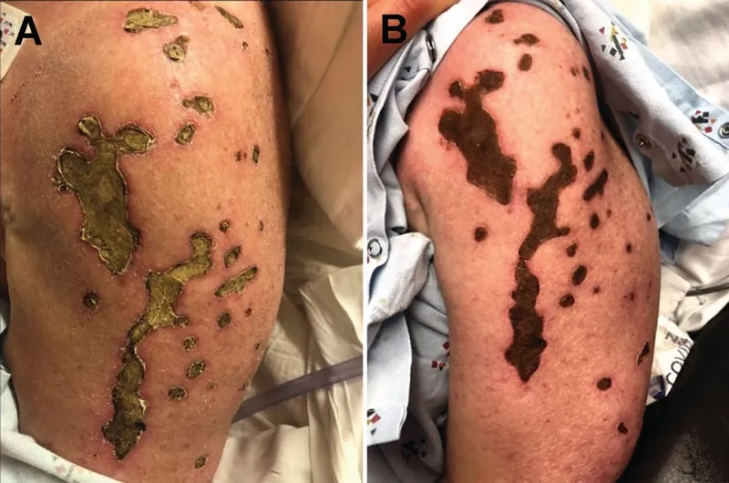 The role of the anti-Jo-1 antibody in diagnosis