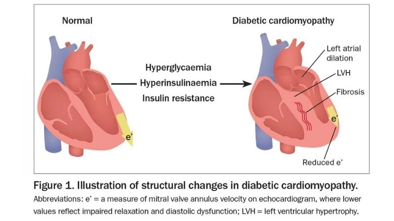 Diabetic cardiomyopathy diagnosis early detection is crucial