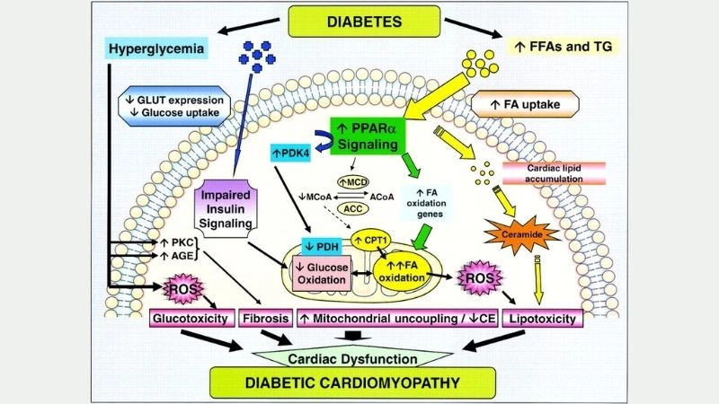 Diabetic cardiomyopathy treatment steps to protect heart health