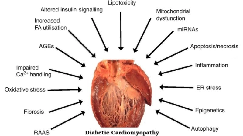 Diabetic cardiomyopathy and heart attack link between conditions