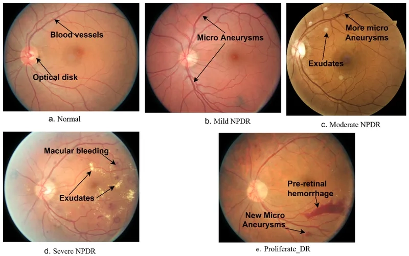 Signs of non-proliferative diabetic retinopathy
