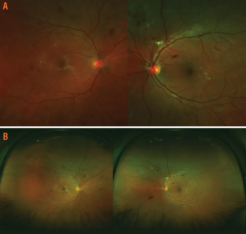 Laser procedure for diabetic retinopathy treatment