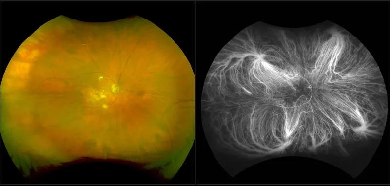 A patient's view showing diabetic retinopathy symptoms
