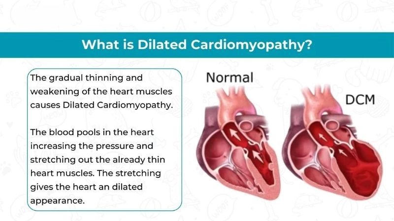 Symptoms of dilated cardiomyopathy include fatigue and breathlessness