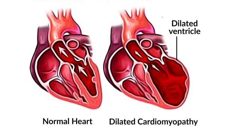 Dilated cardiomyopathy treatment may involve medications or devices