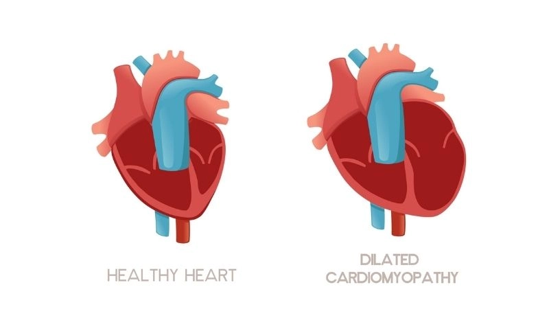 Dilated cardiomyopathy life expectancy varies by severity and management