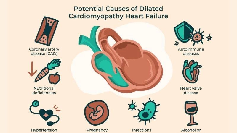 Dilated cardiomyopathy diagnosis relies on echo and MRI