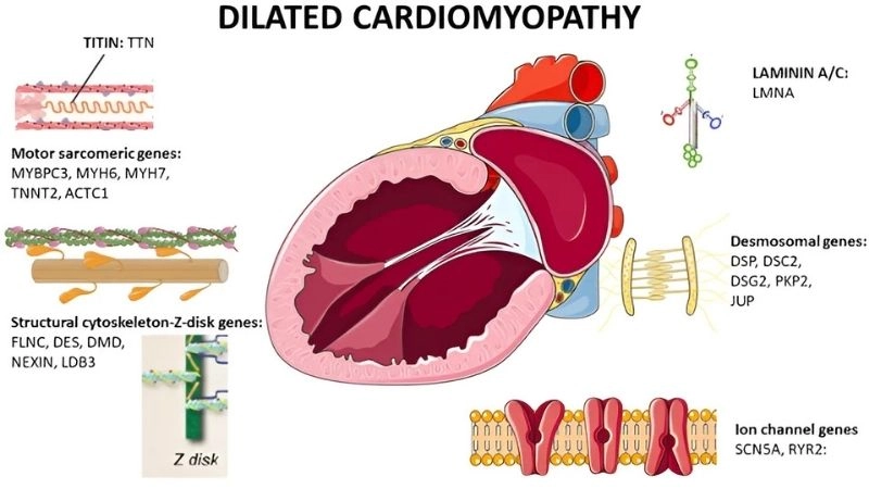 Myocarditis is heart muscle inflammation that may cause DCM