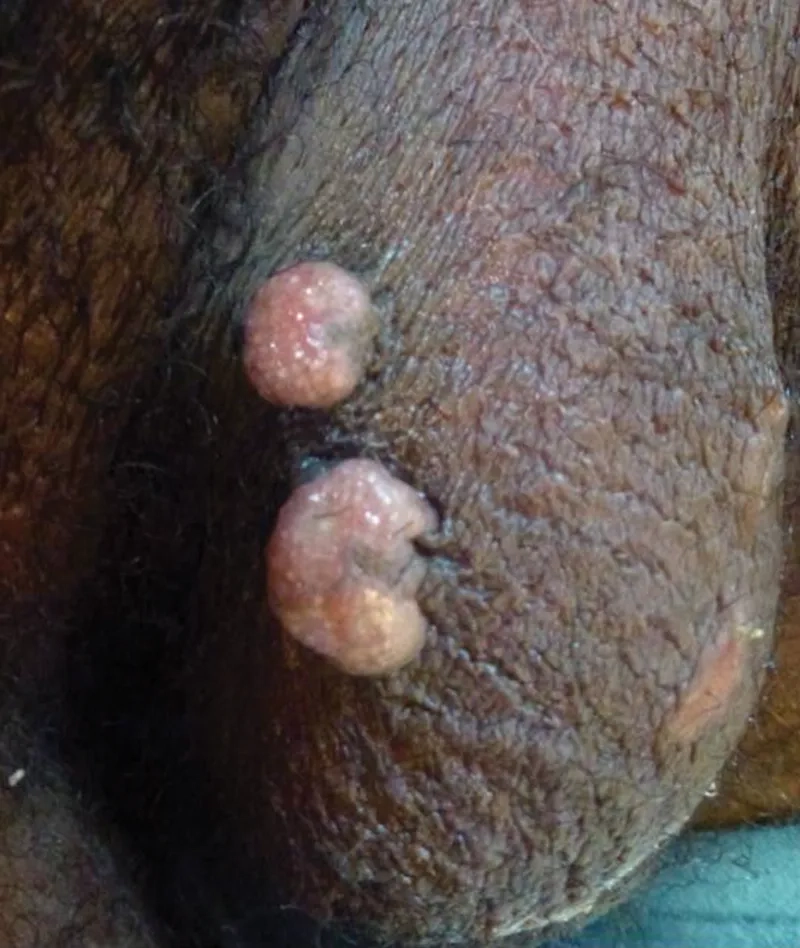 An example of painless genital ulcers