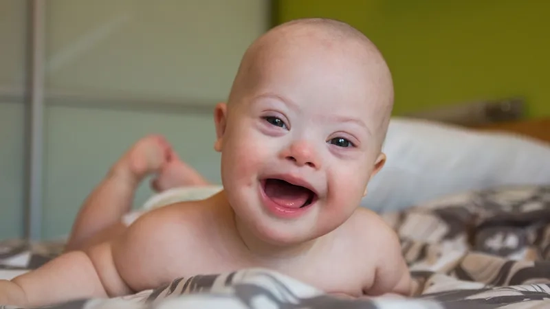 Trisomy 21 genetic condition and health implications