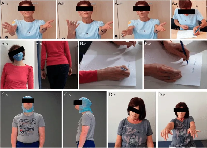 An animation of blepharospasm (eyelid spasms)
