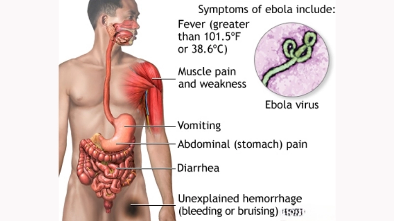 Ebola treatment options for critical cases