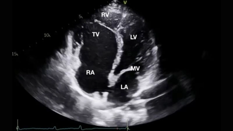 Ebstein's anomaly surgery procedures and recovery guide