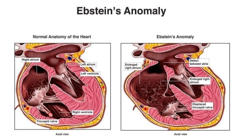 Ebstein's anomaly diagnosis tests and imaging explained
