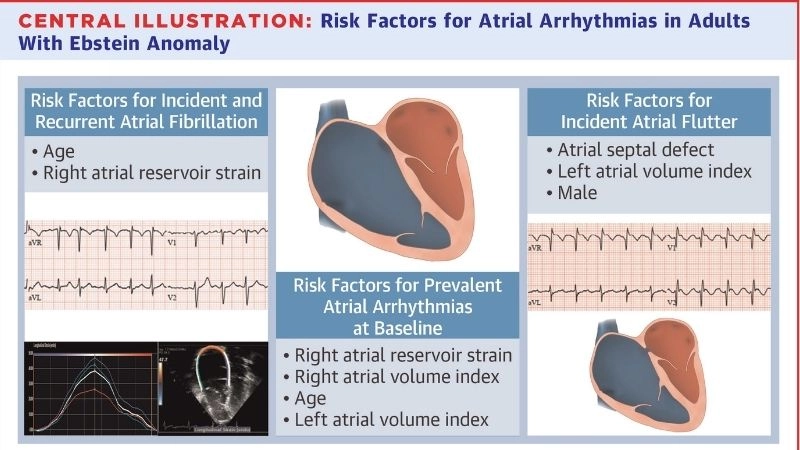 Ebstein's anomaly in infants causes and early detection