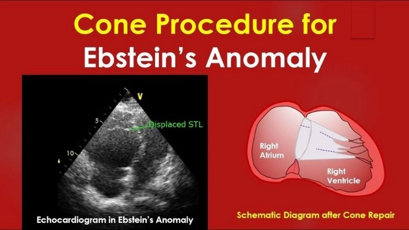 Ebstein's anomaly causes genetic and developmental factors